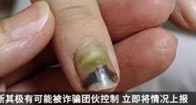 19岁女子被骗缅甸获救时遍体鳞伤！遭电诈集团多次殴打转卖