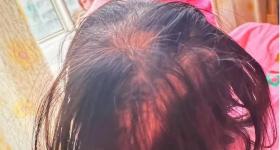 3岁女童突然脱发无法正常行走,查出急性铊中毒