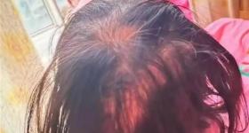 3岁女童脱发、眼神呆滞被查出铊中毒！医院回应