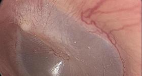 男子和猫同睡耳中长出猫螨虫:米粒大小正在鼓膜上爬行