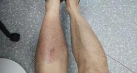 暴雨中蹚了一回水，男子高烧40℃还染上丹毒！医生提醒