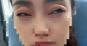 六月顶流水果 女子吃完秒变“悲伤蛙” 医生：罕见却凶险