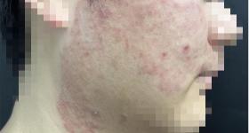 梅雨季高发！1人感染可传染全家，27岁小伙差点毁容……