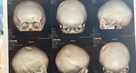 8岁男童被醉汉用椅子砸头:需做开颅手术 母亲讲述事发经过