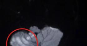 按摩按进急救室？一个动作让男子险丧命！这四类人千万小心
