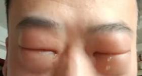 男子吃蚕蛹过敏眼睛肿成“奥特曼”，当事人：人生第一次过敏