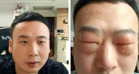男子吃了8只，仅10分钟眼睛肿成“奥特曼”！医生提醒