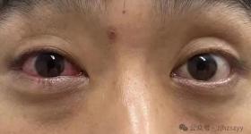 男子遇五步蛇想抓来玩 被喷一脸毒：引起化学性眼损伤