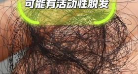 自测！这种实验掉发超过6根，很可能是活动性脱发